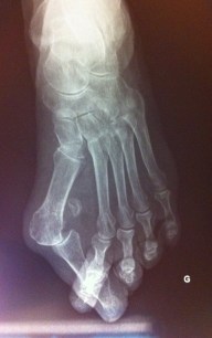 hallux valgus